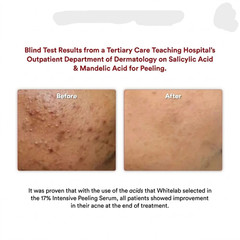 Whitelab 17% Intensive Peeling Serum AHA BHA PHA Exfoliating Dead Skin Care