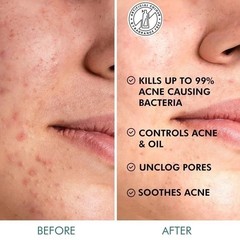 mCaffeine 2% Salicylic Acid Zinc PCA & Matcha Tea Clear Skin Acne Pads – 40N W98