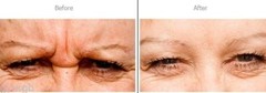 ARGIRELOX® PEPTIDE GLABELLAR FROWN LINE REDUCER 46.53%