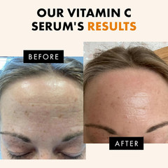 Vitamin C Serum – Skin Care for Dark Spots, Vitamin C Serum for Face with Hyalur