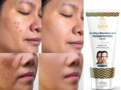 7 DAYS goodbye blemishes & Pigmentation dark Spots Removal Face Cream 100g