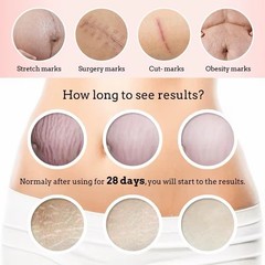 Stretch Marks and Scars Removal Cream for Pregnancy