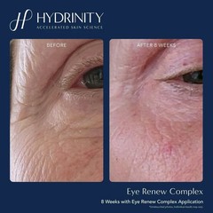 Eye Renew Complex-delivers powerful hydration to the delicate skin around your.