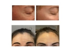 Matrixyl®S6 Forehead Crow&rsquo;s Feet Wrinkle Reduce Peptide