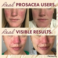 Prosacea ROSACEA GEL Relief: Redness Pimples Irritation MEDICATED HOMEOPATHIC