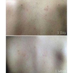 2 Oxe Cure Body Spray Reduce Blemish Treatment Acne on Back Chest Neck Skin 25ml