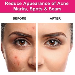 Organic Rosehip Seed Oil for Face, USDA Certified, Cold Pressed, Unrefined, 100%