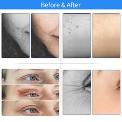 Professional Fibroblast Eyelid Lifting Wrinkle/Spot Removal Laser Plasma Pen
