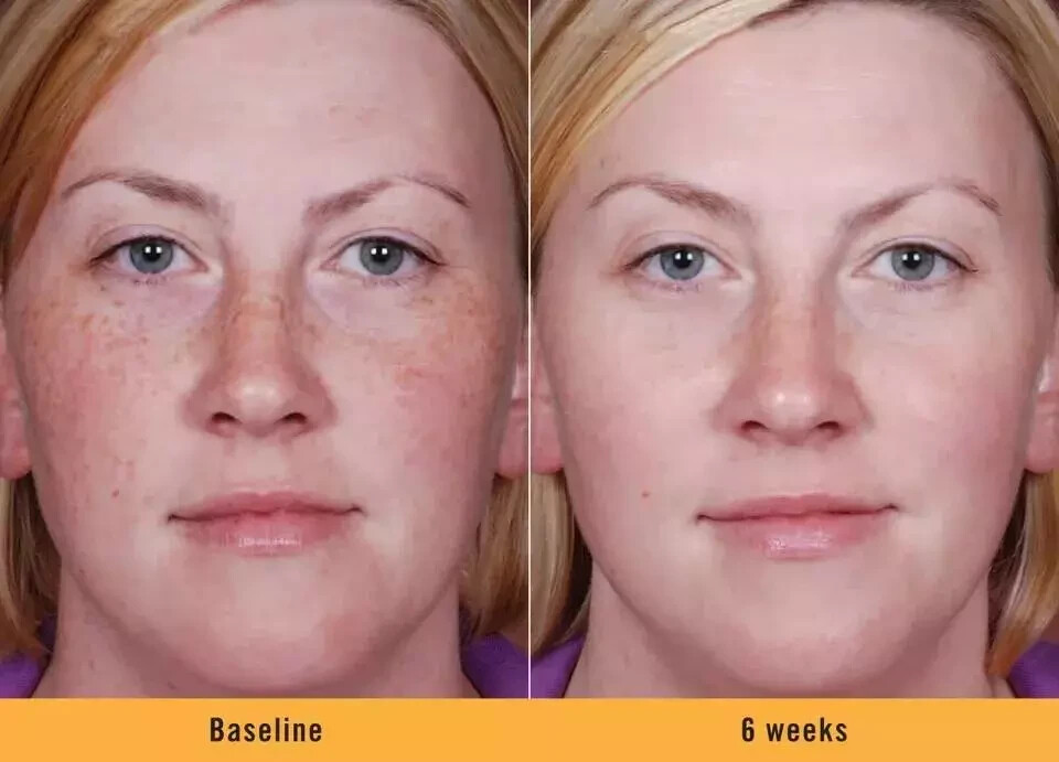 2X KOJIC ACID Skin Whitening Lightening Ultra Brightening Serum Dark Spot cream