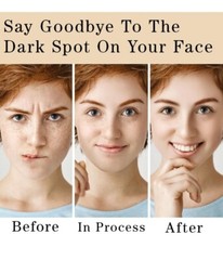 LOVOOD Dark Spot Corrector Cream – Underarm, Neck, Armpit, Knees, Elbows