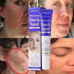 Dark Spots Removal Cream Facial Whitening Freckle Acne Mark Pigmentation Removal