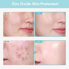 Zinc Oxide 10 Cream, 100,000ppm Zinc Oxide, Heal, Soothe Acne, Redness, Rosac…