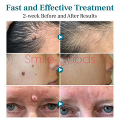 Laser Mole And Wart Removal Laser Pen, Mole Removal Pen, Skin Tag Remova Beauty