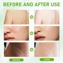 2PCS Bee Venom Skin Restoration Cream, Bee Venom Skin Treatment Cream, Effective