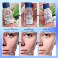 Dr.Leo Acne Essence Salicylic Acid Anti-acne Serum Lighten Acne Scars acne NEW