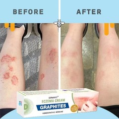 SKIN OINTMENT BODY PSORIASIS DERMATITIS ECZEMA NATURAL TREATMENT CREAM 25G