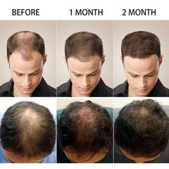 2 pcs Kormesic 5% Hair Growth Scalp Massage Cream Professional Hair Care100g