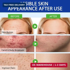 Folliculitis & Acne Treatment Cream Salicylic Acid & Herbal Extracts for Scalp,