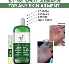 Thyme Out plus Eczema Treatment Psoriasis Treatment Treats Acne Dermatitis Skin
