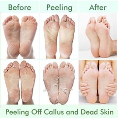 5 Pack Foot Peeling Mask,Exfoliator Peel Off Calluses Dead Skin Callus…