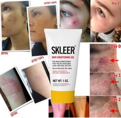 Best Scar Gel and Stretch Mark Removal Gel- Breakthrough treatment for Acne