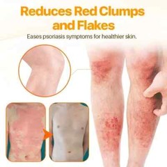1 Pack Crema Para Dermatitis Eczema Psoriasis Para Comezon Picazon Ronchas En La