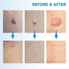 2in1 Skin Tag Remover Kit Micro Device Safe Removal 2-8 mm Painless Tool