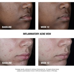 Neutrogena Stubborn Acne AM Face Treatment 2 Ounce (Pack of 1),