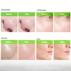 Blooskim Charcoal Blackhead Remover Mask, Herbal Clean Oily & Combo Skin, 80ml