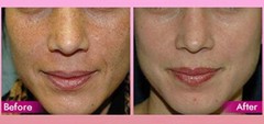 GLYCOLIC ACID 20% CHEMICAL PEEL 1 OZ AHA WRINKLES ACNES BLACKHEADS SKIN FACE
