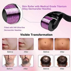 0.5mm 1mm 1.5mm 2.0mm 540 Microneedle Scar Derma Roller Dermaroller