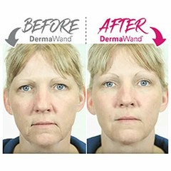 DermaWand PRO Newest Model – Factory Refurbished – 1 Year Warranty – See Images