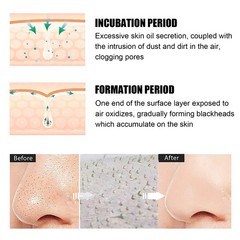 Blackhead Remover Nose Mask Deep Cleansing Pore Strips Acne Peel Off Face Care