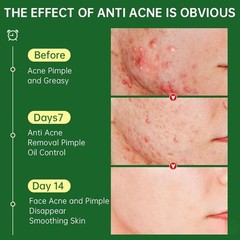 Natural Acne Removal Cream for Oily & Combination Skin | Clears Pimples & Pores