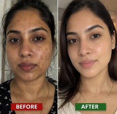 Skin Brightening Cream Faster Brightening for Dark Spots & Hyperpigmentation