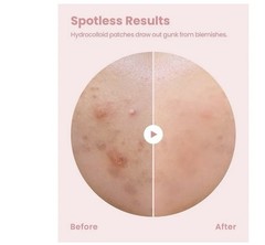 GLAM UP Spotless Smart Patch Hydrocolloid Acne Patches Waterproof Matte 36 ct