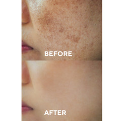Dark Spot Corrector Serum Dark Spot Remover for Face with Alpha Arbutin