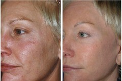 AntiAging SkinCare Kit for Older Skin-Cleanser, Serum, Peel, Toner, Moisturizer