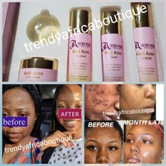 5pc anti Acne treatment set: face soap, toner, cleanser, serum + face cream sale