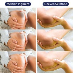 Intimate Areas Skin Lightening Bleaching Cream for Body Sensitive Intimate Area,