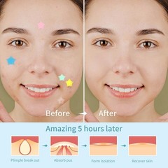 REDANHA 200 Count Star Pimple Patches for 1 (Pack of 200), The Stars