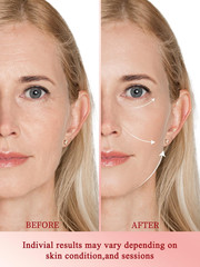 Radio Frequency Skin Tightening Device, Anti-Aging Face Machine, Wrinkle