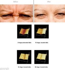 ARGIRELOX® PEPTIDE GLABELLAR FROWN LINE REDUCER 46.53%