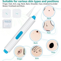 Painless Skin Tag Remover Device Kit Auto Safe Removal 1-9 MM Band Tool Home Use