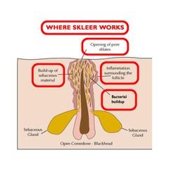 SKLEER – Blackhead & Whitehead removal & prevention of Recurrence