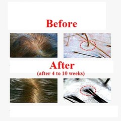 Revitalize Your Hair: 6-SPROUT EXOSOME (CH6) & Growth Factor Scalp Serum (140ml)