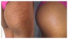 Anti Cellulite Massage Oil-Tones Skin & Breaks Down Fat Tissue