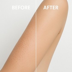 Microdermabrasion Keratosis Pilaris, Folliculitis & 8 Ounce (Pack of 1), Bar
