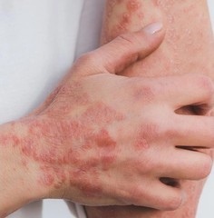 Crema Para Dermatitis Eczema Psoriasis Para Comezon Picazon Ronchas En La Piel