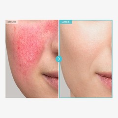Zinc Oxide 10 Cream, 100,000ppm Zinc Oxide, Heal, Soothe Acne, Redness, Rosac…